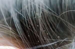 Can Hair Color Kill Lice? 3 Shocking Facts